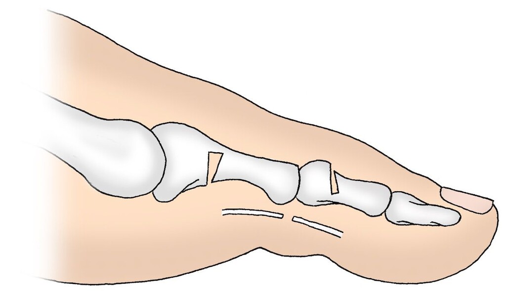 Fuß nach erfolgreichem Eingriff