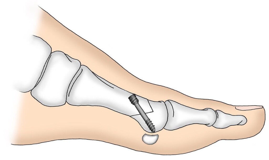 Behandlungsoption für Hallux Valgus