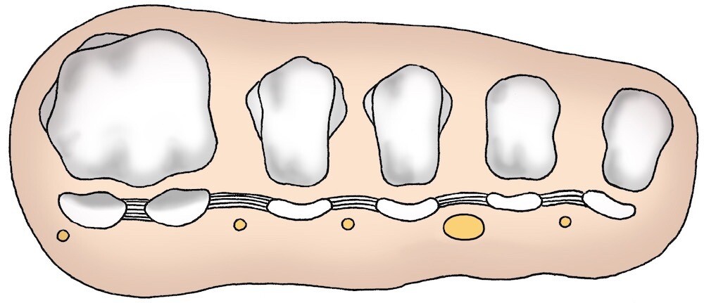 Morton-Neuralgie von Vorne