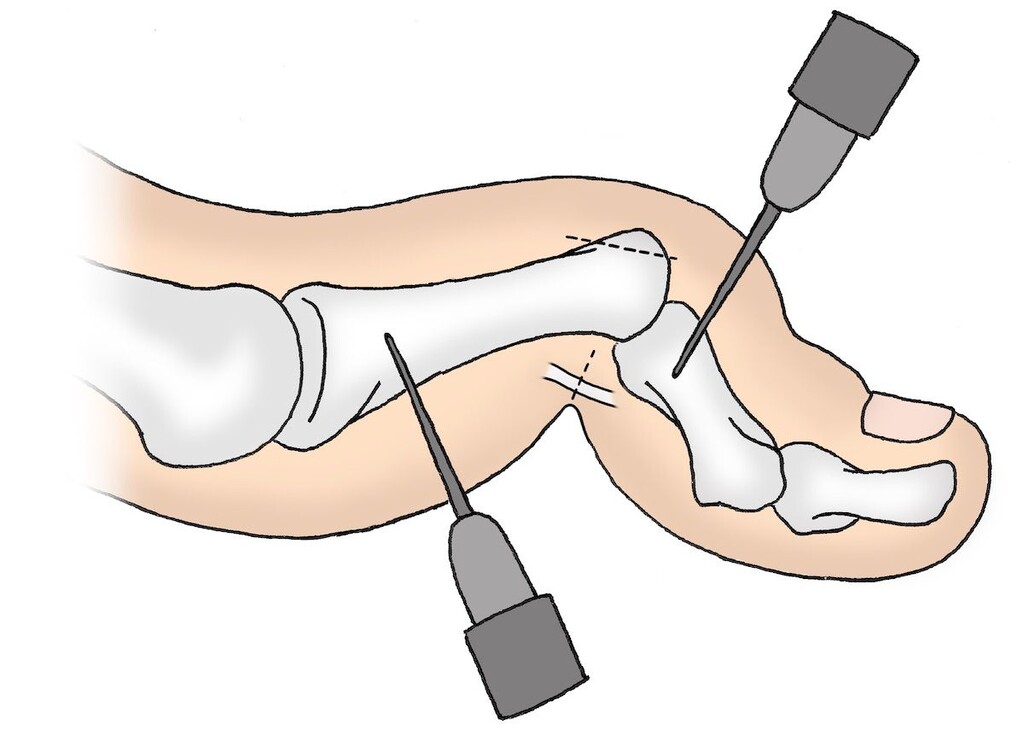 Eingriff bei einem Hammerzehe