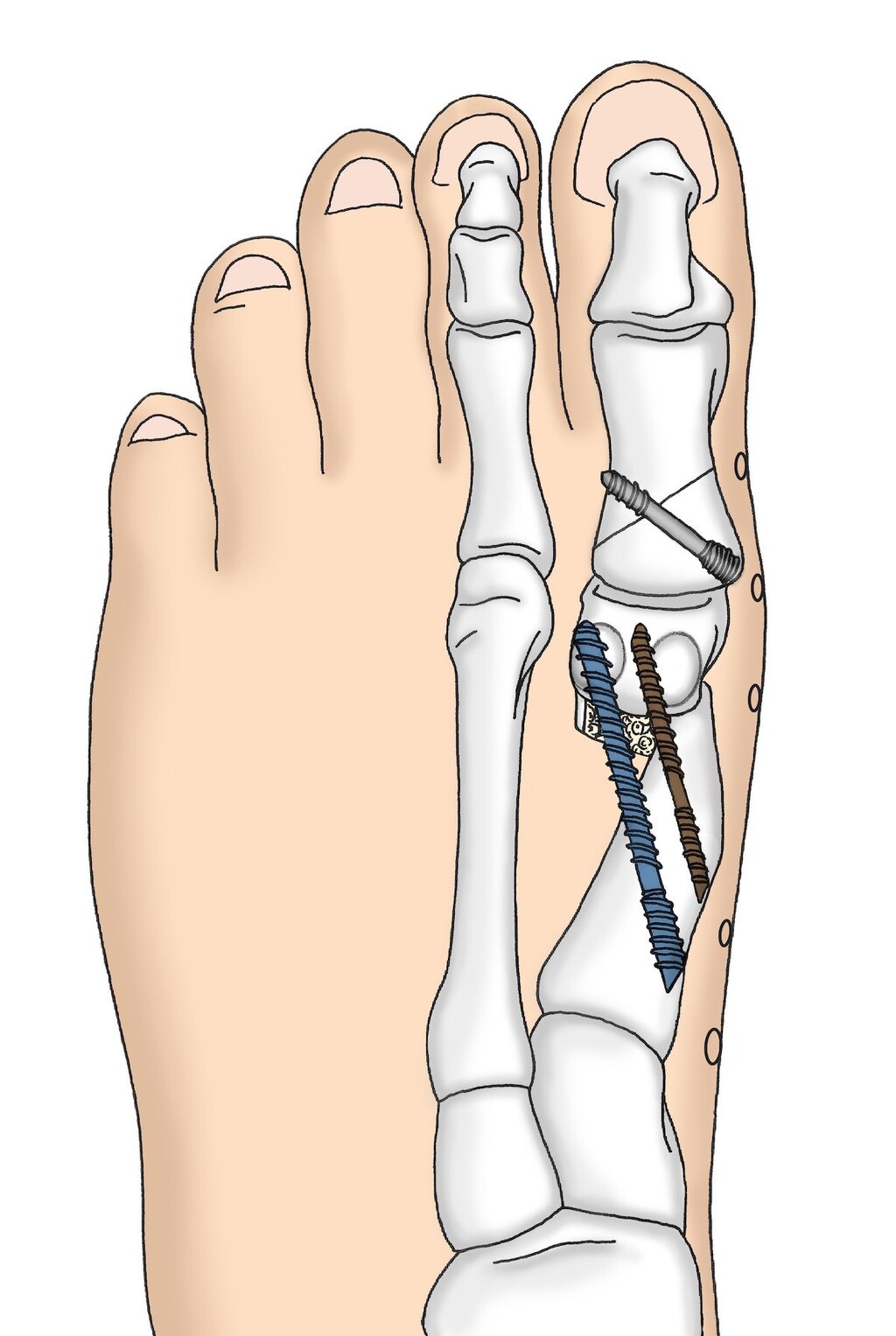 Behandlungsoption für Hallux Valgus