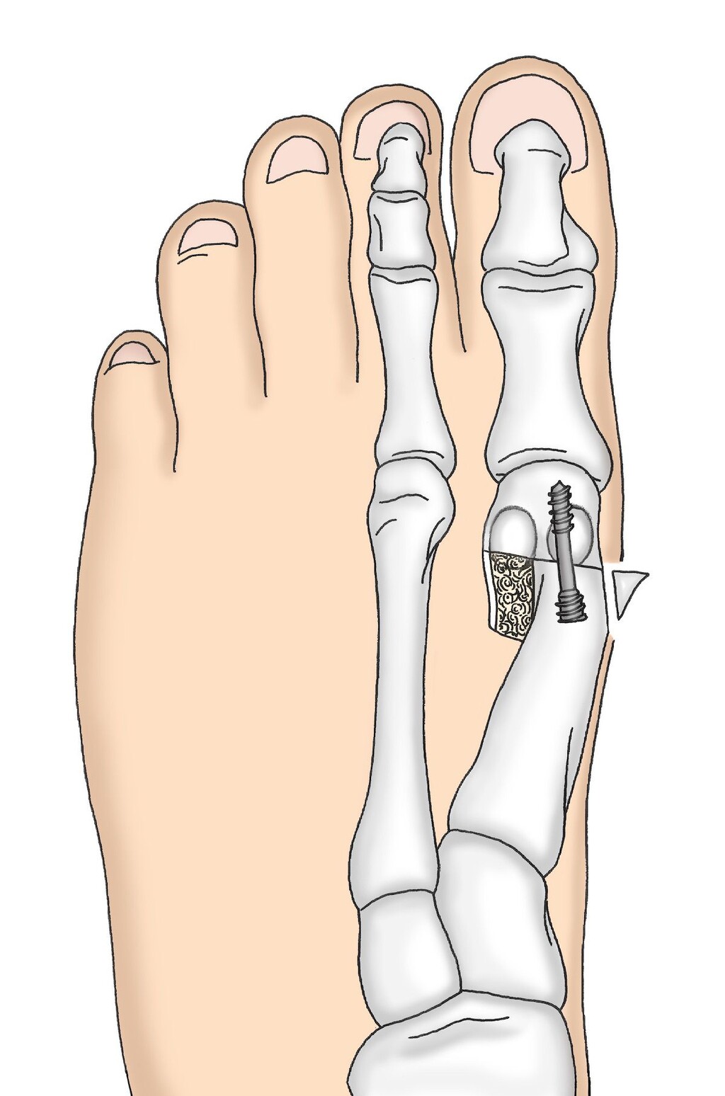 Behandlungsoption für Hallux Valgus