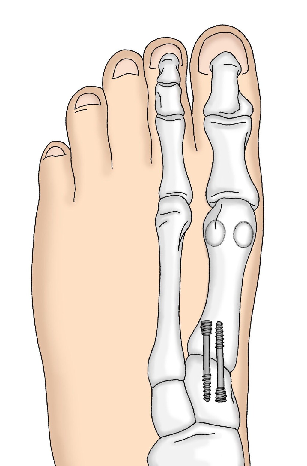 Behandlungsoption für Hallux Valgus