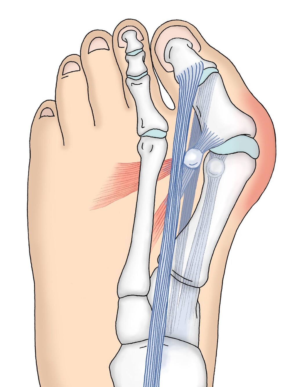 Hallux Valgus